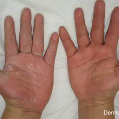 Manos con piel seca y escamosa en la izquierda, que podría indicar que significa cuando te pica la mano derecha. La mano derecha se ve sana.