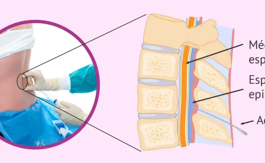 Dolor meses después de una epidural ¿cuándo consultar?