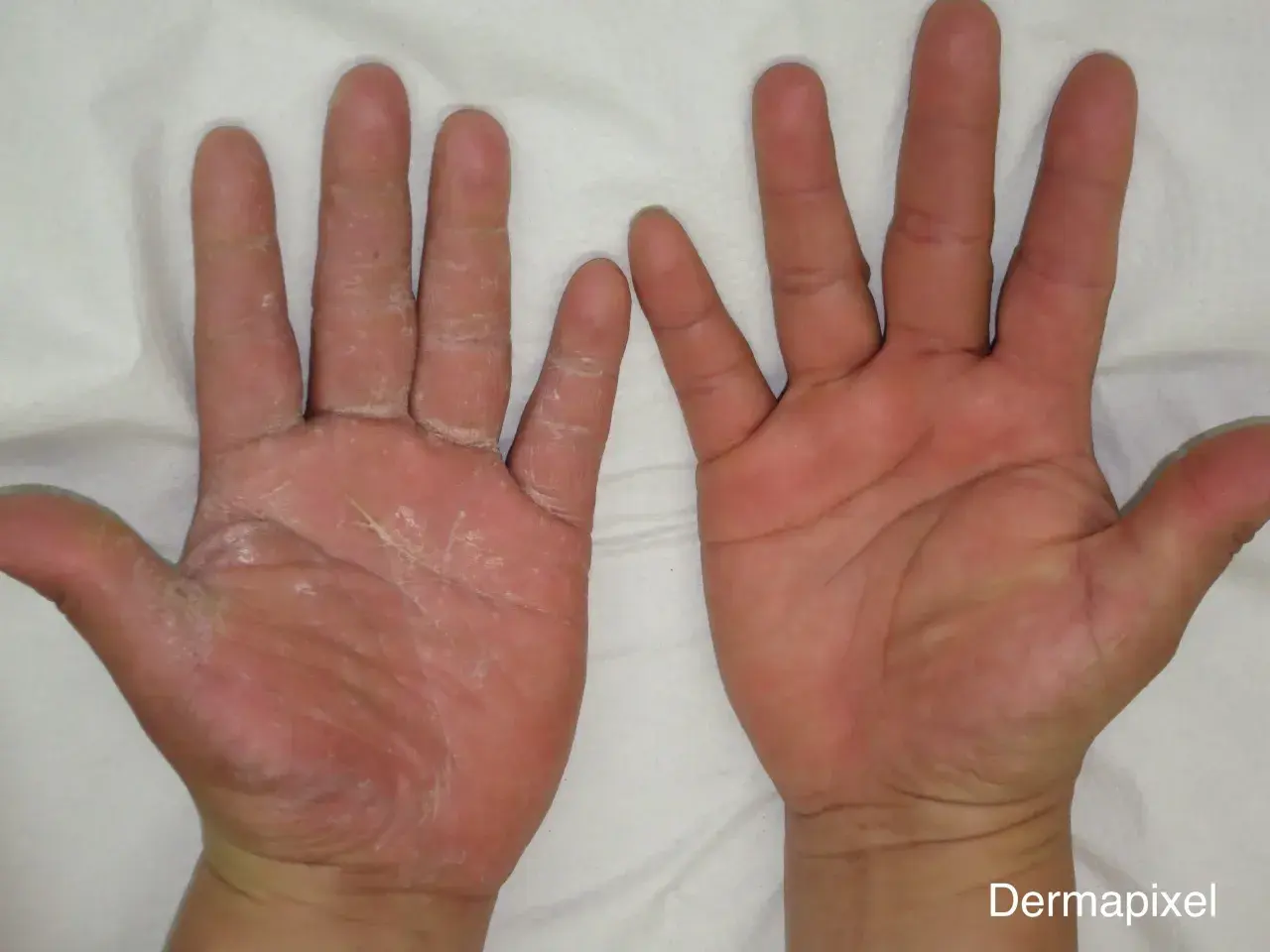 Manos con piel seca y escamosa en la izquierda, que podría indicar que significa cuando te pica la mano derecha. La mano derecha se ve sana.