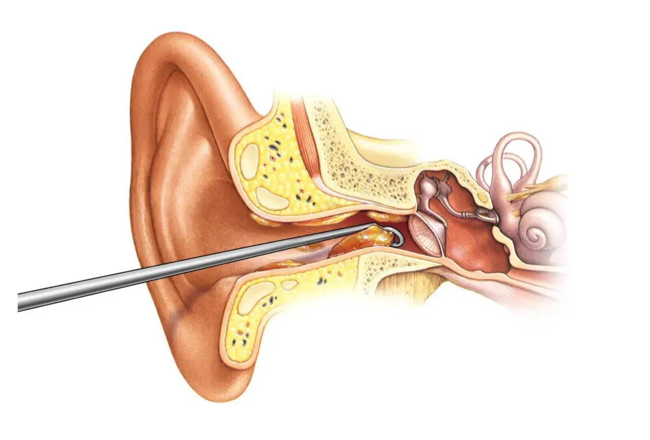 Instrumento extrae un tapón de cera del oído. El cerumen obstruye el canal auditivo, afectando la audición.